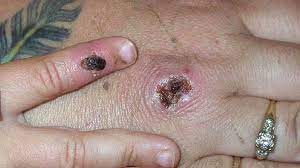 Jun 11, 2021 · two cases of monkeypox have been identified in north wales. Monkeypox Two Cases Identified In North Wales Bbc News