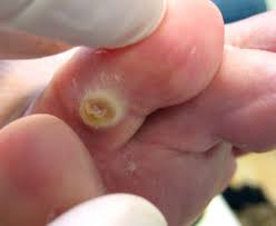 Mắt cá chân, mụn cóc không cần tiểu phẫu dùng thuốc đặc trị xuất xứ Anh  an toàn tuyệt đối