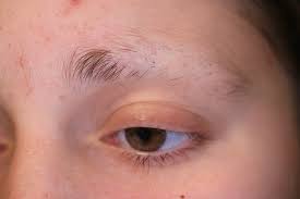eyebrow and eyelash alopecia a