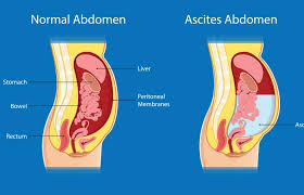 15 home remes for ascites types