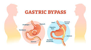 your stomach pouch after gastric byp