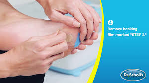how to use callus removers with duragel