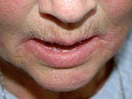 yeast infection on the face causes and