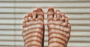 red toes symptoms causes and treatments