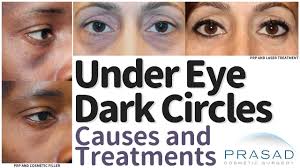 what causes under eye dark circles and