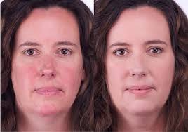 Overproduction of melanin, the pigment responsible for skin and hair color. Breathable Natural Looking Coverage Of Rosacea And Uneven Skin Tones Mineral Air Takes Away The Redn Airbrush Foundation Uneven Skin Tone Skin Imperfection