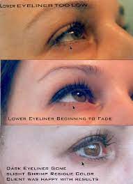 tattoo removal eyebrows eyeliner