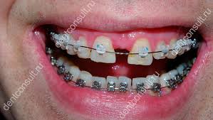 Как убрать щель между зубов? | DentConsult | Дзен