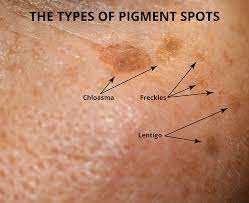 hyperpigmentation brown spots what are