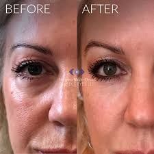 Is getting filler for undereye bags safe? Tear Trough Fillers A Solution To Dark Circles Eye Bags Hollows