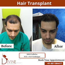 hair transplant and hair loss treatment