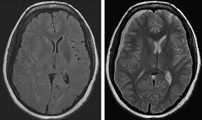 Subdural hematoma vs epidural hematoma. Postmicrodiscectomy Brain Magnetic Resonance Imaging Demonstrating A Download Scientific Diagram