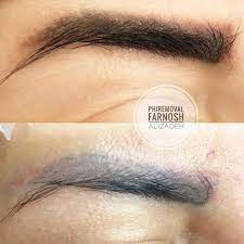 glycolic acid microblading removal and