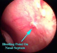 nasal nose pictures and photos