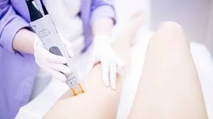 can pregnant women get laser hair removal