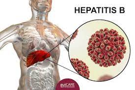 Hepatic steatosis is essentially fatty liver. Hepatitis B Treatment Symptoms Costs In Singapore Gutcare