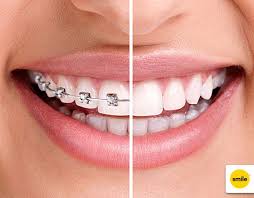 A good rule of thumb is that you will need your retainer just a little longer than the amount of time you had your braces in. Should I Wear My Retainer And Other Questions About Braces