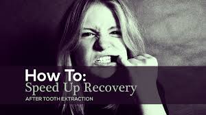 recovery after tooth extraction