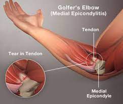 elbow al epicondylitis