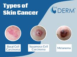 skin cancer screening the derm