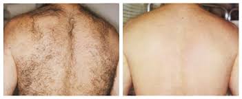 Folliculitis occurs when a hair follicle gets infected. Folliculitis After Laser Hair Removal
