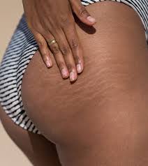 stretch marks on the causes and