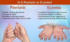 Image result for Eczema
