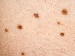The mutations can quickly cause cells to grow out of control and turn into a mass. What Are The Symptoms Of Skin Cancer Cdc