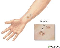 vesicles information mount sinai