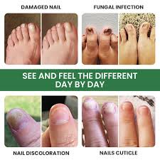 fungal nail treatment for toe nail