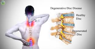 what is degenerative disc disease