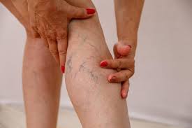 are spider veins dangerous to my health