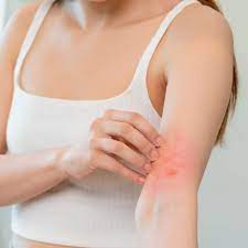 eczema treatment symptoms causes