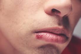 cold sore treatment blister