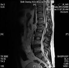 This is commonly seen in ankylotic disorders. L1 And L2 Compression Fracture Spinal Injury