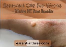 essential oils for warts effective