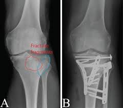 tibial plateau fracture treatment