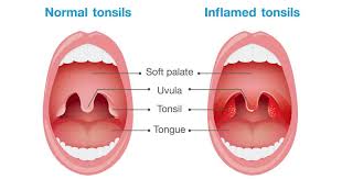 Removing Your Tonsils Is A Bad Idea
