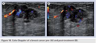 Color Doppler Sonography Characterizing Breast Lesions