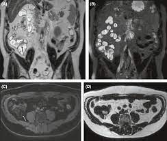 lipomatosis of the ileocecal valve a