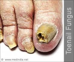 toenail fungus causes symptoms