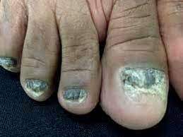 nail dystrophy of the toes with