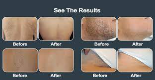 diode laser hair removal all skin type