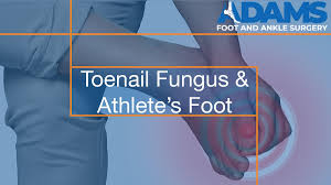 toenail fungus athlete s foot adams