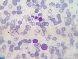 A Case Of Chronic Myeloid Leukaemia Presenting As Megakaryocytic