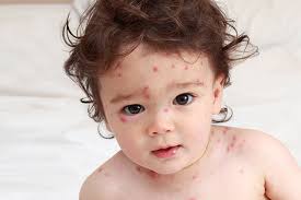 8 Serious Causes Of Acne In Toddlers