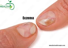 nail diseases common types and