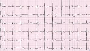 The Pediatric Ecg And Long Qt Syndrome Emra