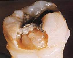 Tandtrollen karius och baktus bor inne i jans mun. Karies Ist Die Haufigste Ursache Von Zahnschmerzen