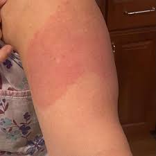 Eight days after the vaccine, my arm became hot, red. If You Have A Skin Reaction To The Moderna Covid 19 Vaccine Don T Panic
